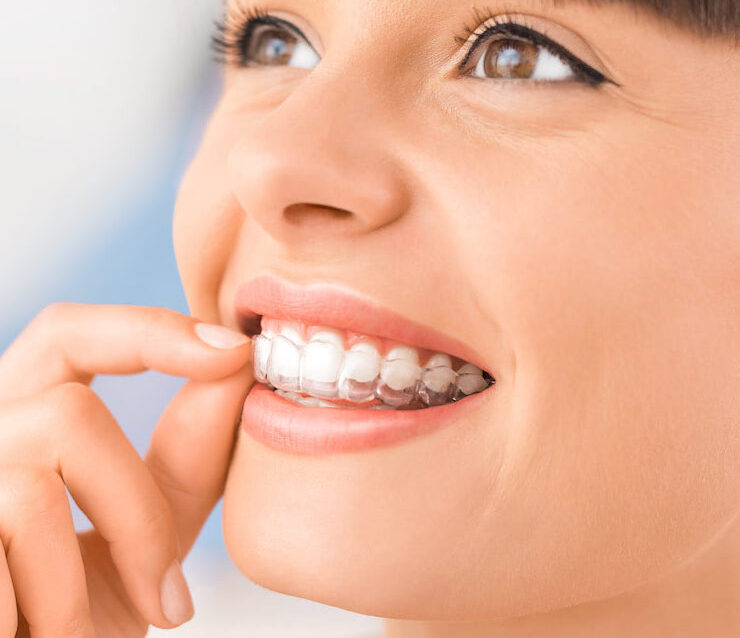 allineatori-trasparenti-per-adulti-blog allineatori-trasparenti-per-adulti-blog