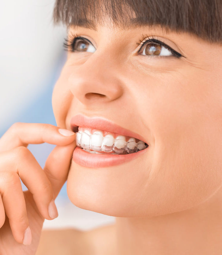 allineatori-trasparenti-per-adulti-blog allineatori-trasparenti-per-adulti-blog